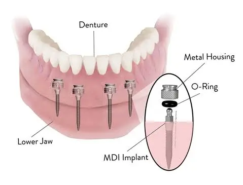 Mini Dental Implant Solutions of Muskegon MI