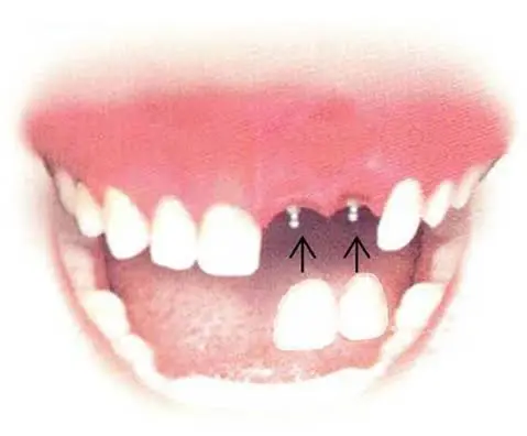 Mini Dental Implant Solutions of Muskegon MI