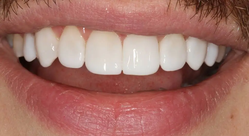 SmileBOND