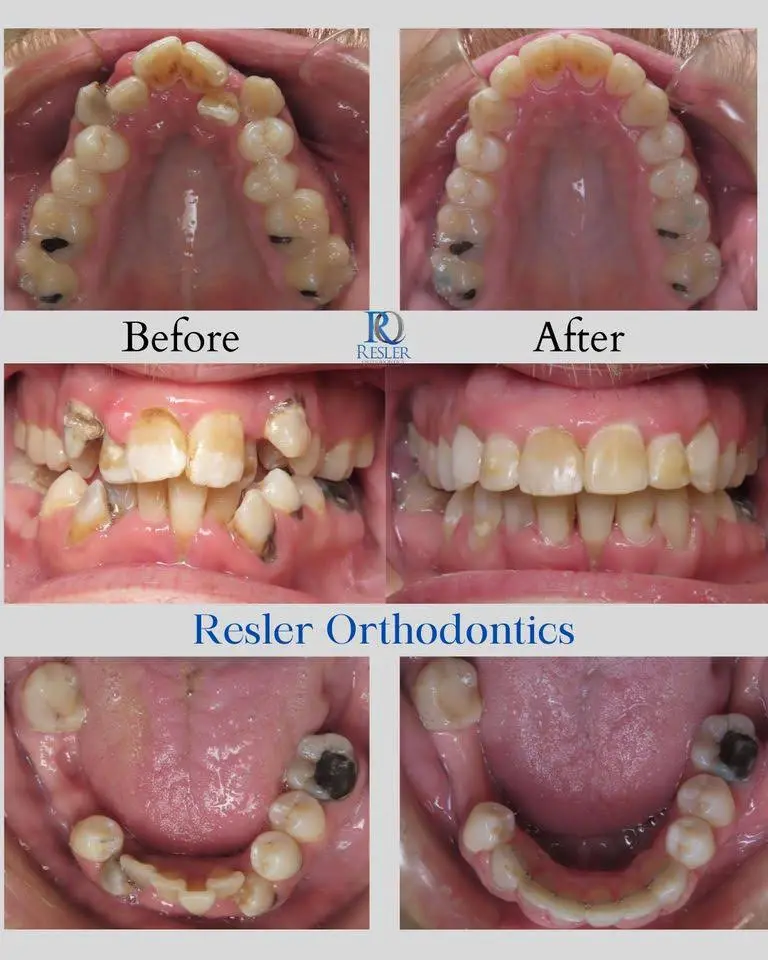 Resler Orthodontics - Caro