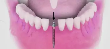 Dental Implant Solutions Decatur MI