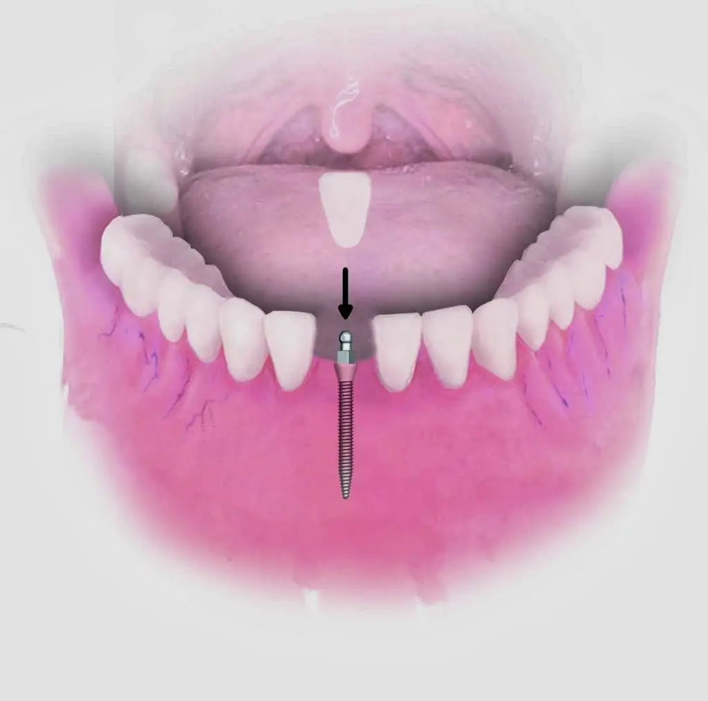 Dental Implant Solutions Decatur MI