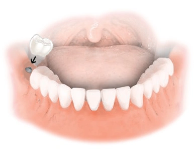Dental Implant Solutions Decatur MI