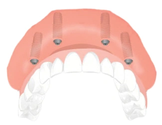 Dental Implant Solutions Decatur MI