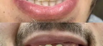 Wolverine Cosmetic Dental