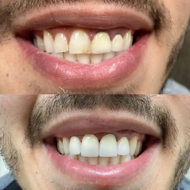 Wolverine Cosmetic Dental