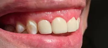 Restoration Dental