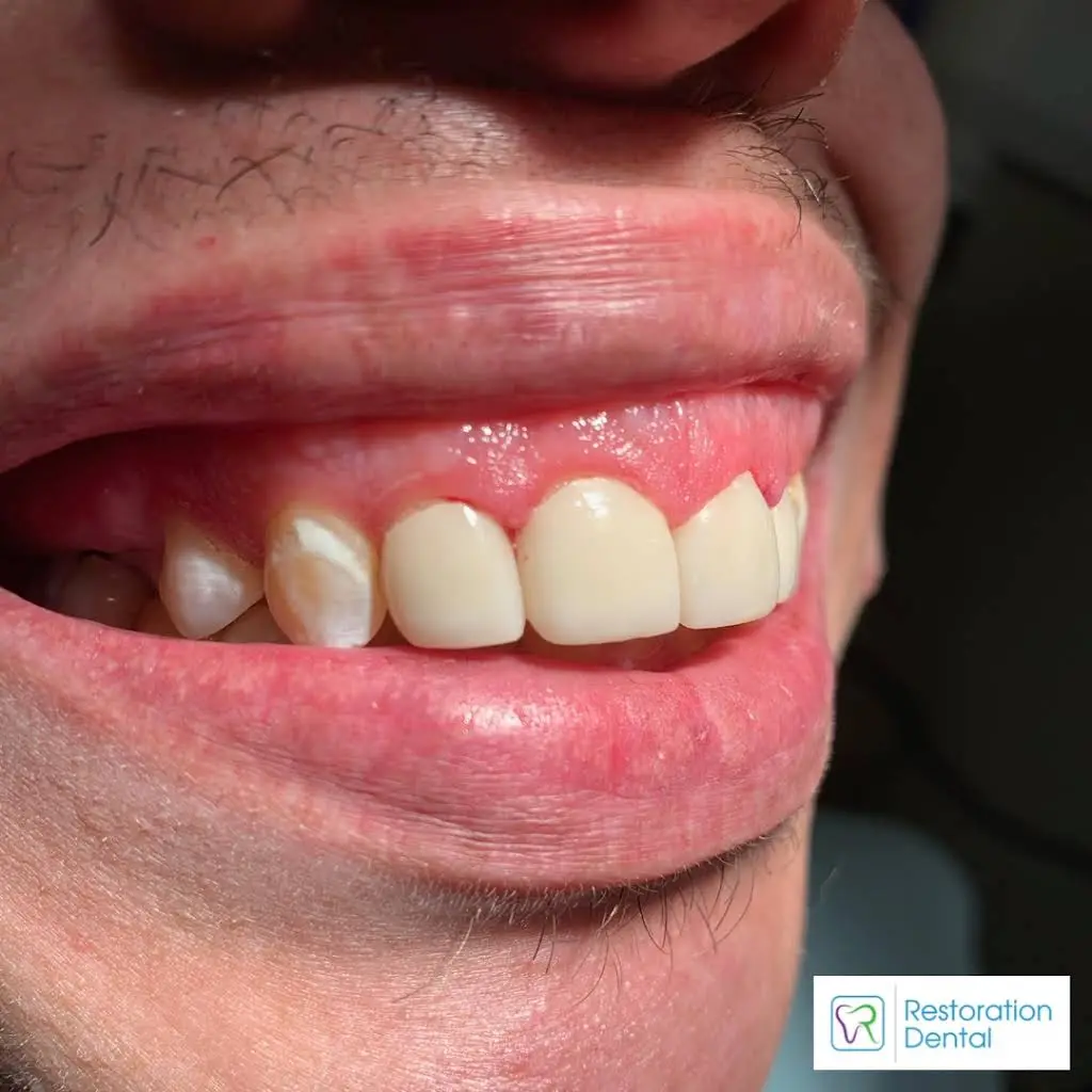 Restoration Dental