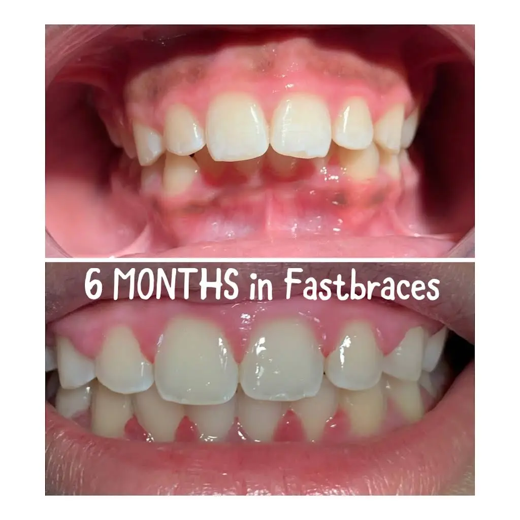 Restoration Dental