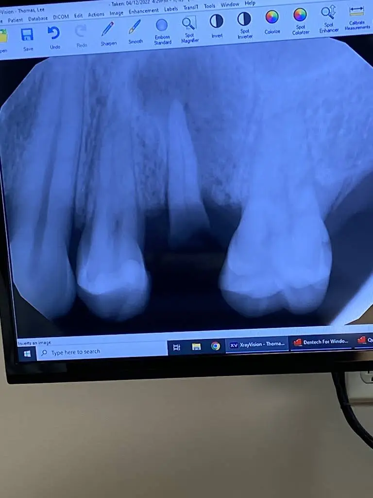 Superteeth