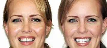 Painless Dentistry