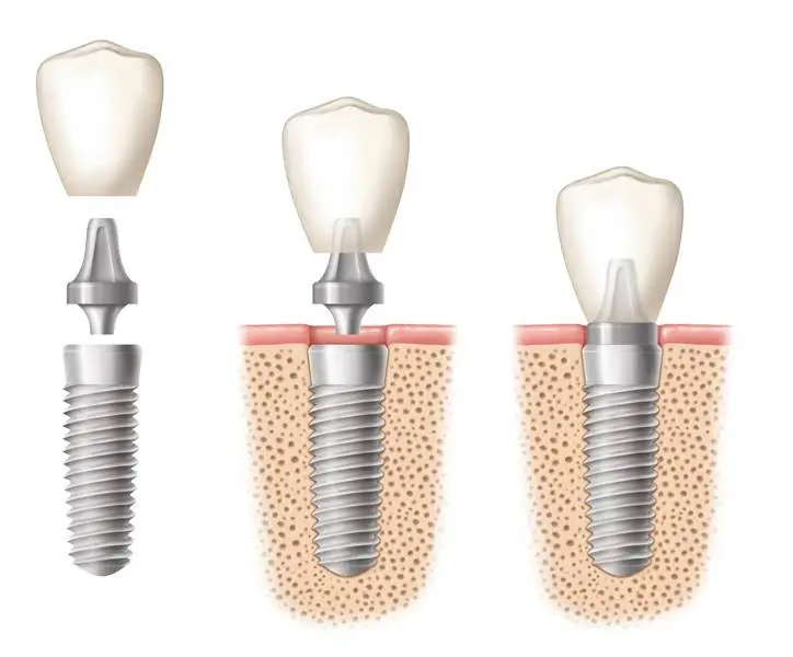 Perio Plastic & Implantology Center of Kokomo