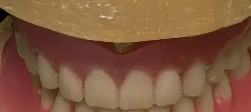 Affordable Dentures & Implants