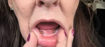 Affordable Dentures & Implants