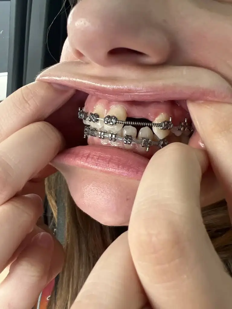 Braces For U