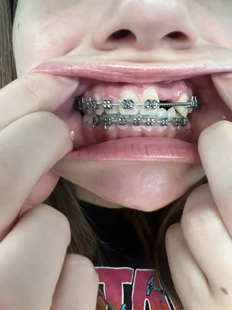 Braces For U