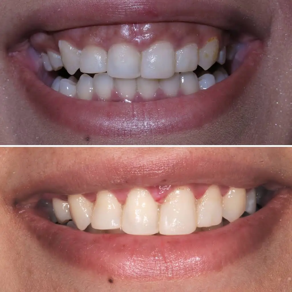 Limelight Dental