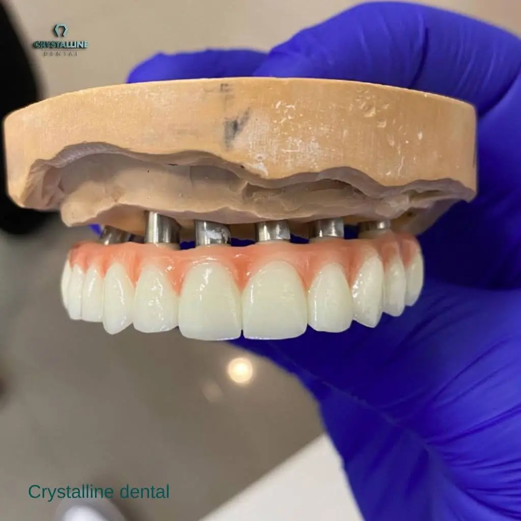 Crystalline Dental