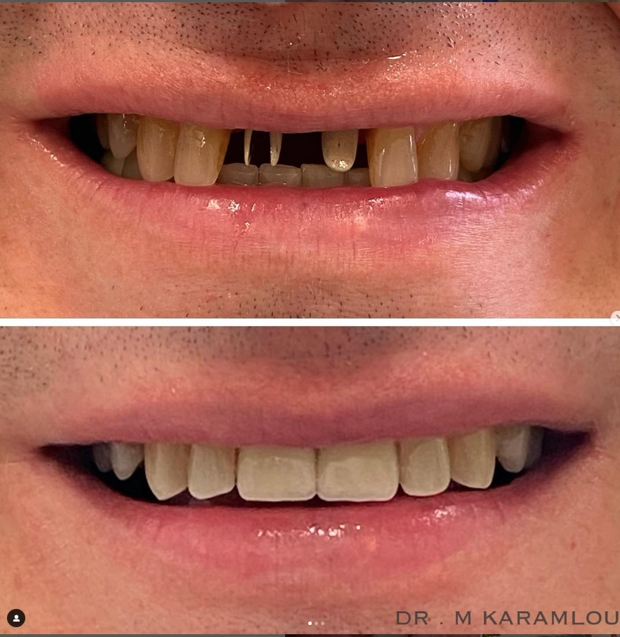 Crystalline Dental