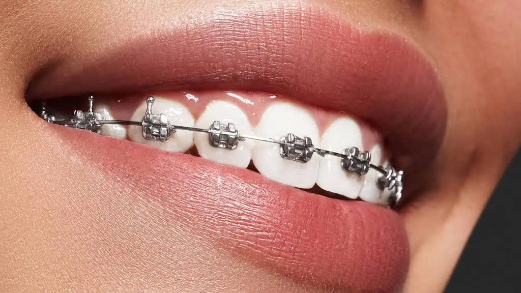 Braces4U
