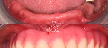 Revive Smiles - Dental Implants
