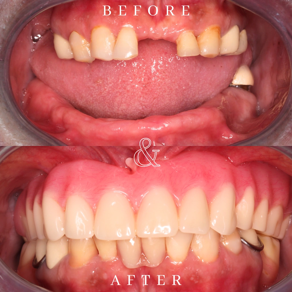 Revive Smiles - Dental Implants