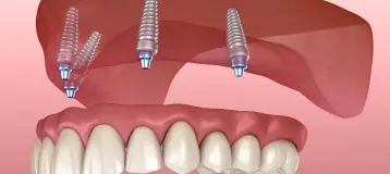 Walker Oral Surgery