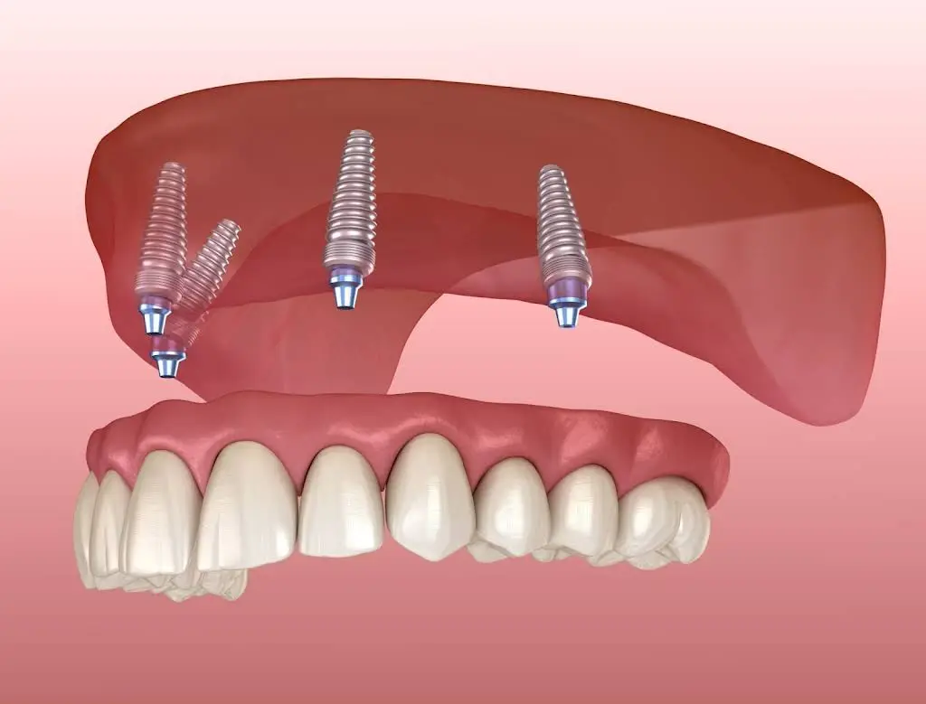 Walker Oral Surgery