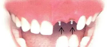Dental Implant Solutions Parma Heights, OH