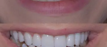 Dental Implants Cleveland / Rocky River Dental