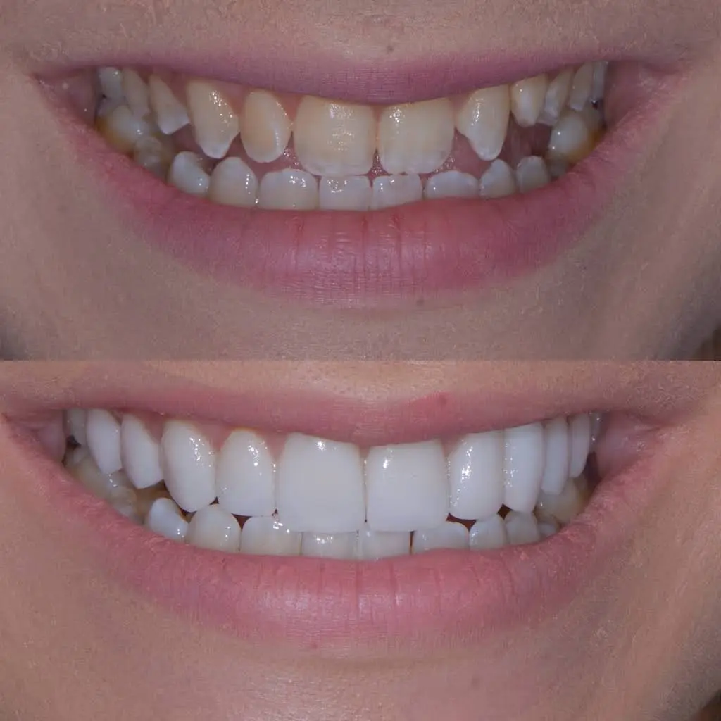 Dental Implants Cleveland / Rocky River Dental