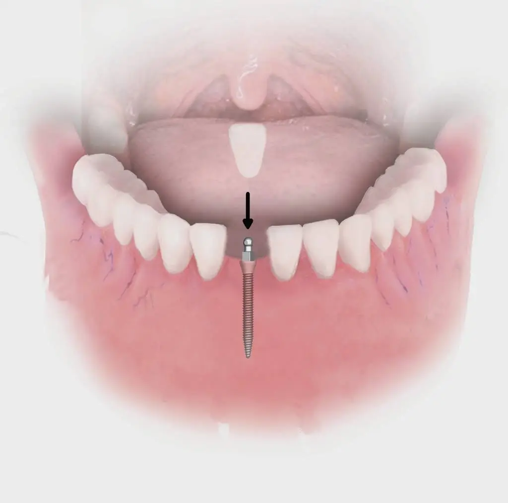 Scott W Powers DDS Family & Implant Dentistry