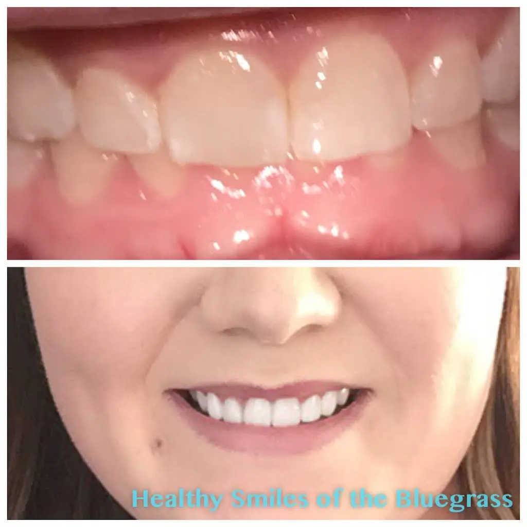 Healthy Smiles of the Bluegrass, PLLC