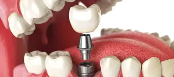 Louisville Oral Surgery & Dental Implants