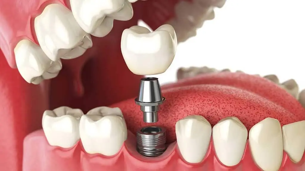 Louisville Oral Surgery & Dental Implants