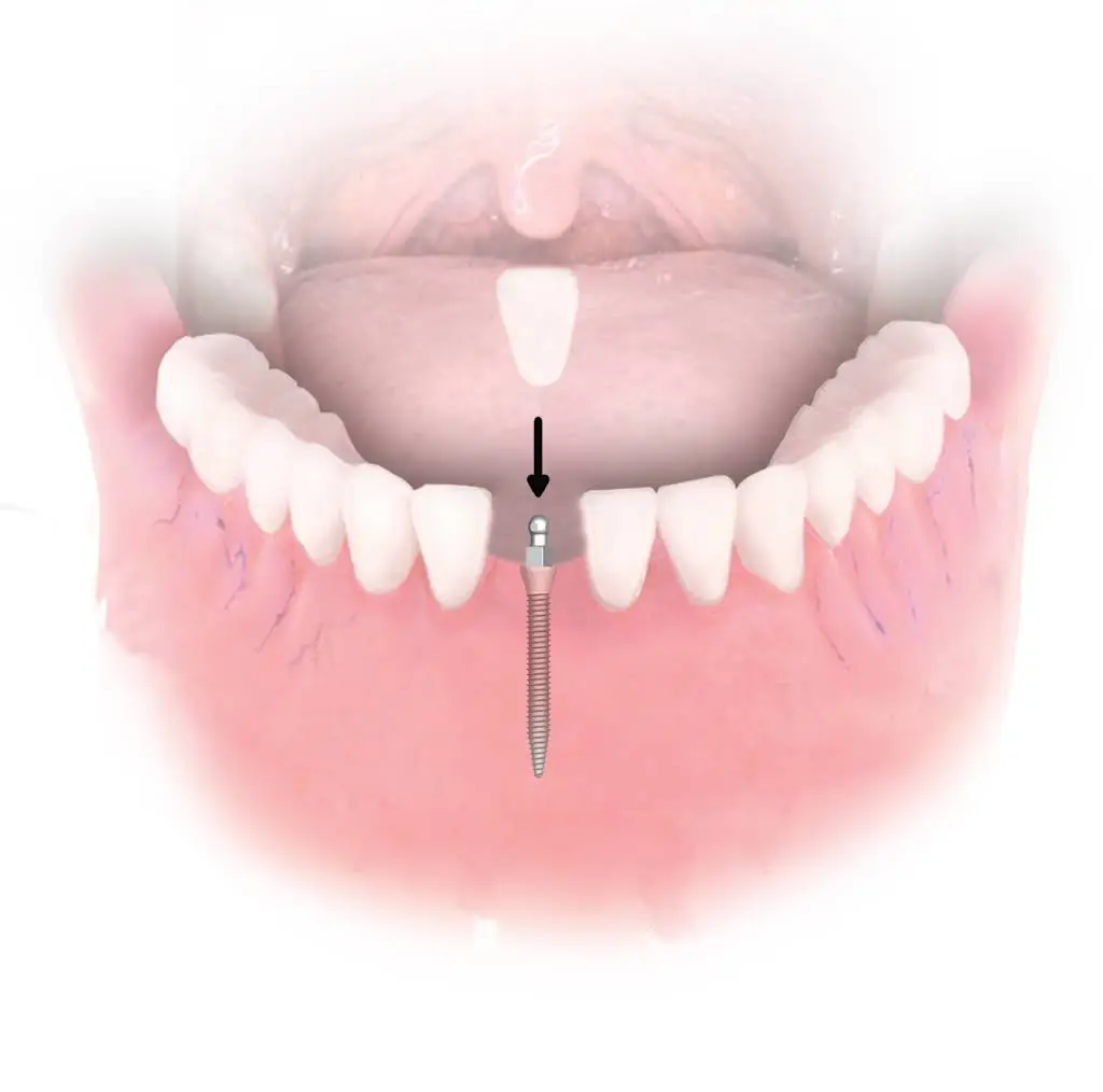 Dental Implant Solutions Prestonsburg, KY