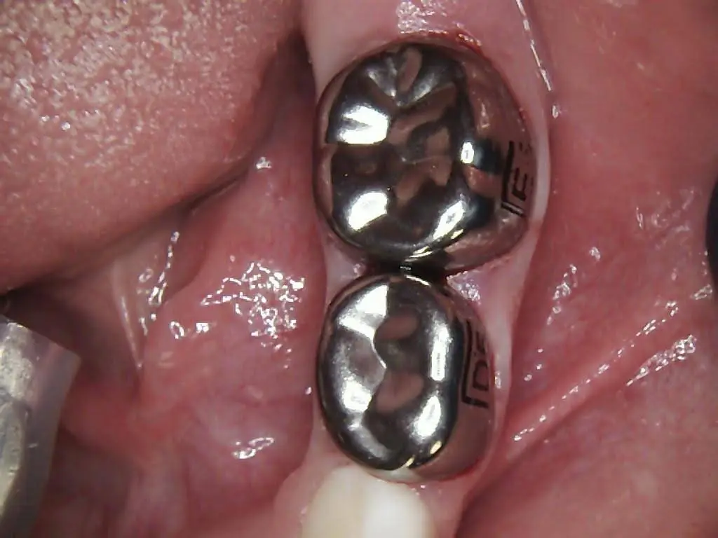 Dental Care for Kids