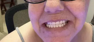 Affordable Dentures & Implants
