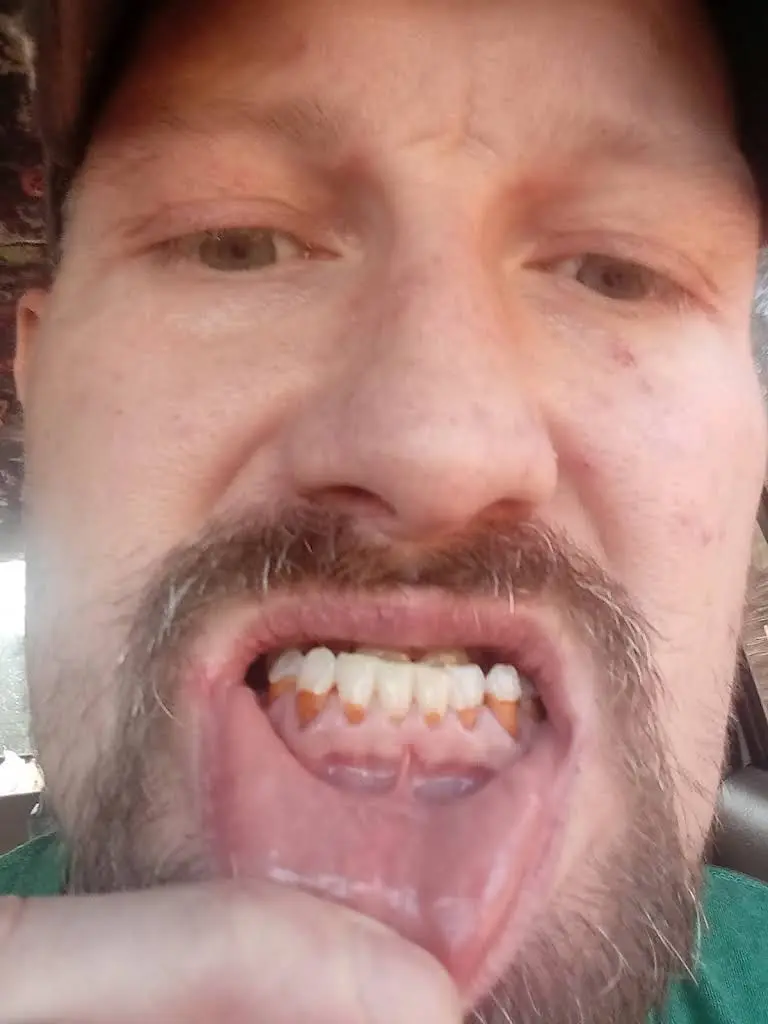 Affordable Dentures & Implants