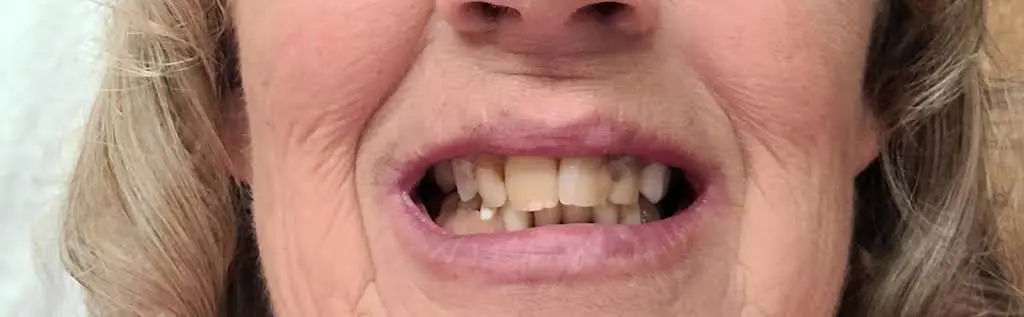 Affordable Dentures & Implants