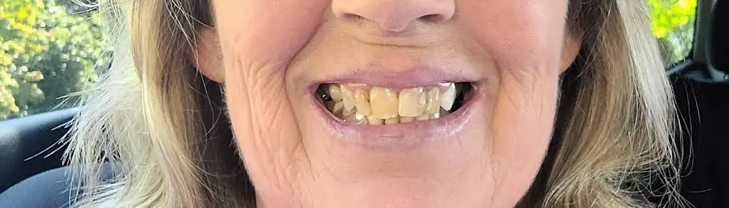 Affordable Dentures & Implants