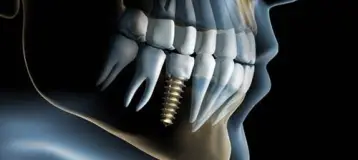Metro West Dental & Implant Institute