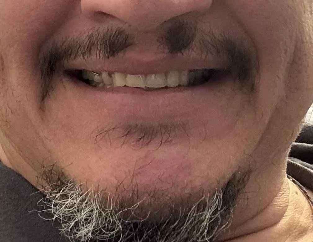 Affordable Dentures & Implants