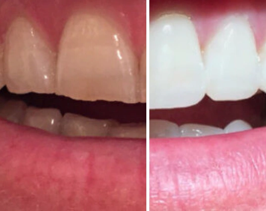 Bell Dental Maryland Heights