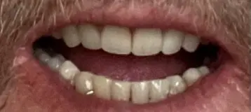 Affordable Dentures & Implants