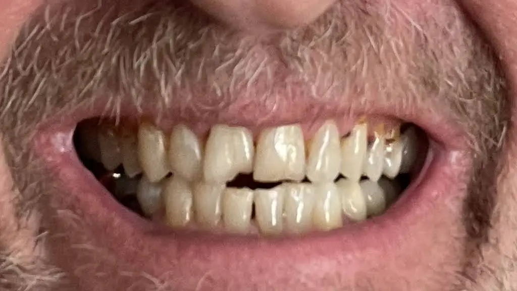Affordable Dentures & Implants
