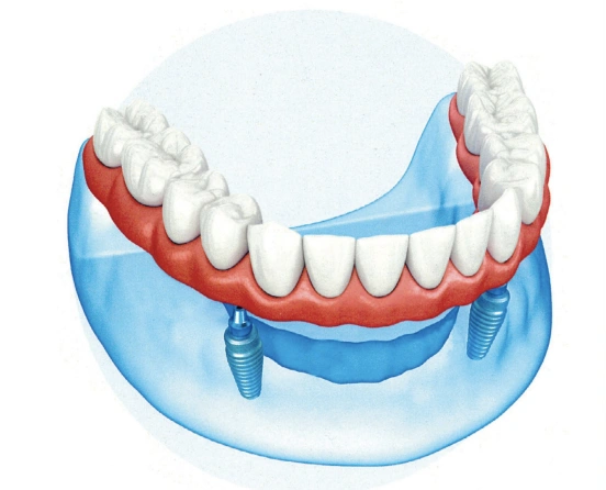 Hillview Dentures and Implants