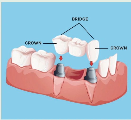 Hillview Dentures and Implants