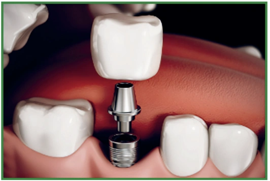 Hillview Dentures and Implants