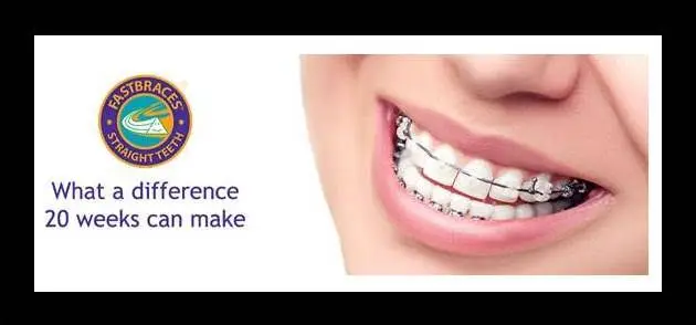 Fast Braces St. Charles